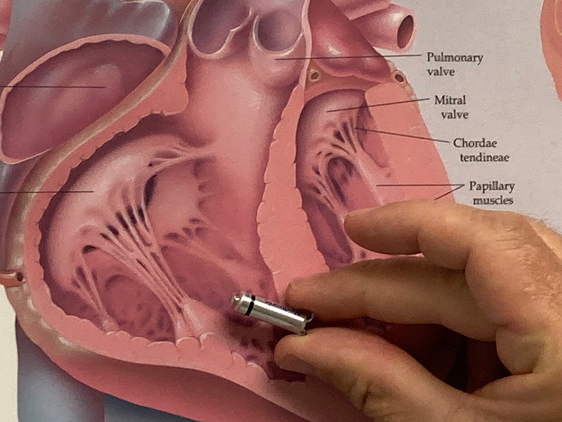 micra-leadless-pacemaker-with-heart-diagram